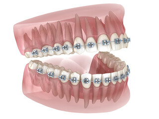 Metal braces and transparent dental model. Medically accurate 3D illustration