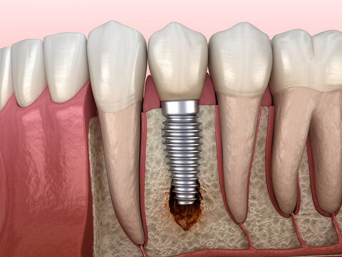 Periimplantitis with visible bone damage. Medically accurate 3D illustration