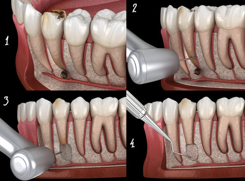 Tooth Cystectomy Surgery - recovery after Periostitis . Dental 3D illustration