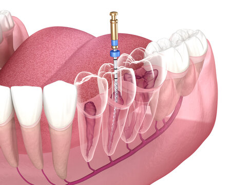 Endodontic root canal treatment process. Medically accurate tooth 3D illustration.