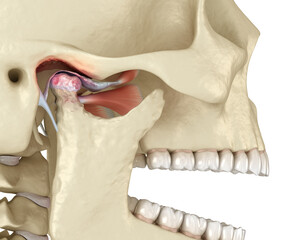 Temporomandibular joints arthritis and dislocated articular disc. Medically accurate 3D illustration. - 521976644