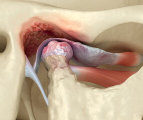 Temporomandibular joints arthritis and dislocated articular disc. Medically accurate 3D illustration. - 521976650