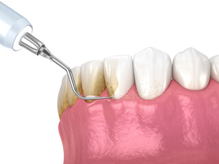 Oral hygiene: Scaling and root planing (conventional periodontal therapy). Medically accurate 3D illustration of human teeth treatment