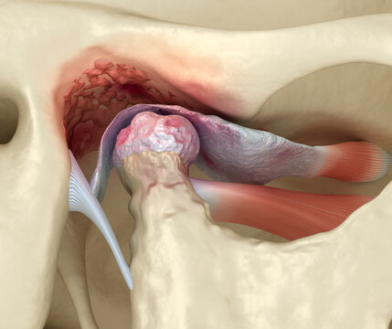 Temporomandibular joints arthritis and dislocated articular disc. Medically accurate 3D illustration.