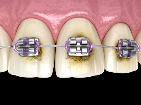 Caries process near braces as result by poor hygiene. Medically accurate 3D illustration of oral hygiene.