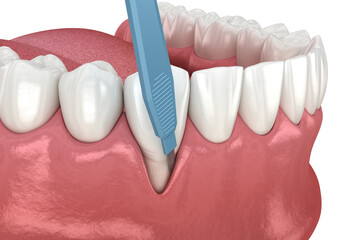 Gum Recession: Soft tissue graft surgery. 3D illustration of Dental  treatment