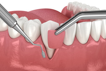 Gum Recession: Soft tissue graft surgery. 3D illustration of Dental  treatment - obrazy, fototapety, plakaty
