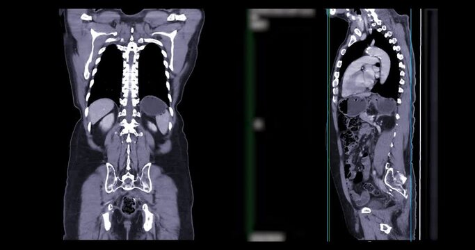CT Chest and abdomen with contrast media for diagnosis chest and  abdominal pain.