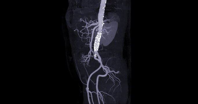 CTA abdominal Aorta for diagnostic abdominal aortic aneurysm or AAA. 