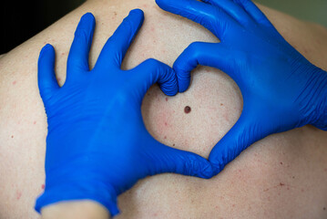 a doctor in blue gloves shows a heart symbol on the background of a patient's birthmark