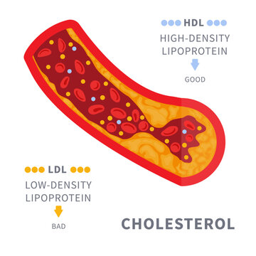 Narrowed blood vessel with cholesterol plaque buildup. Artery blocked with a fat cells clot. ldl and hdl lipoprotein comparison. Cross section medical diagram. Vector illustration.