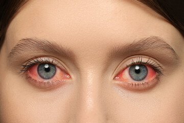 Obraz premium Closeup view of woman with inflamed eyes