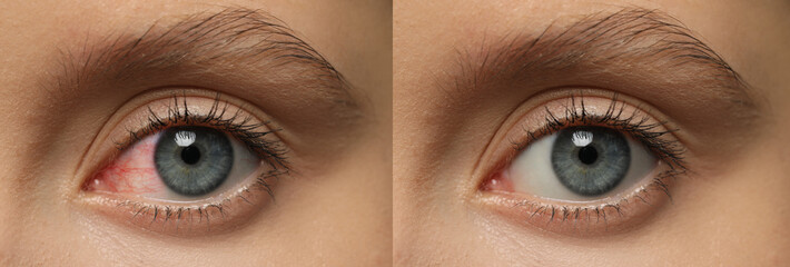 Collage with photos of woman with inflamed and healthy eyes before and after treatment, closeup....