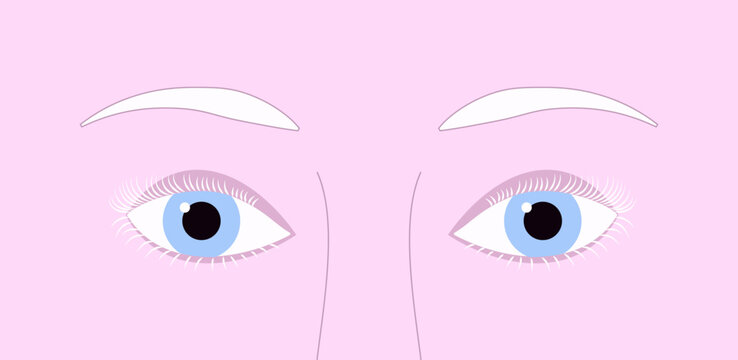 Closeup light blue eyes of albino person with pink skin and white depigmented eyelash and eyebrows