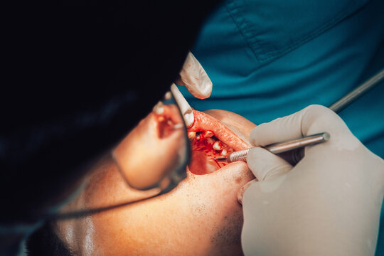 Details during dental surgery 