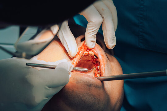 Details during dental surgery 