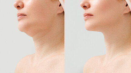 Female double chin before and after correction. Correction of the chin shape liposuction of the neck. The result of the procedure in the clinic of aesthetic medicine. - obrazy, fototapety, plakaty