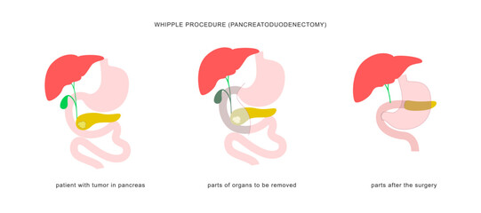 Medical infographic of whipple procedure pancreaticoduodenectomy. Surgery operation in treatment of pancreatic cancer. - obrazy, fototapety, plakaty
