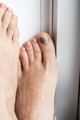 Feet in need of treatments, injuries and nail bruising. Concept, illustrative of need for health...