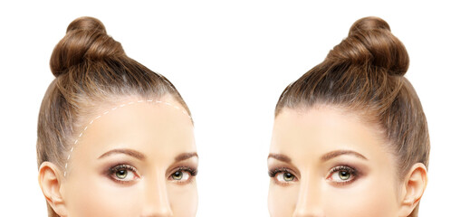 Alopecia Areata,female pattern baldness,Treatment for hair loss,Hair transplant,Surgery to implant...