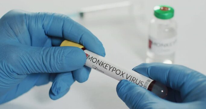 Hands of doctor holding vial with monkeypox virus