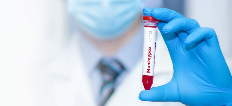 Doctor holding a test blood sample tube with monkey pox virus (MPXV)