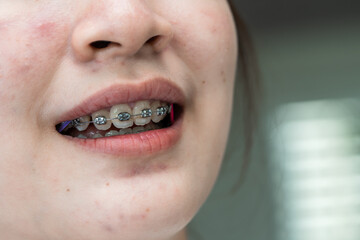 Braces in teenage girl mouth to treat and beauty for increase confidence and good personality.