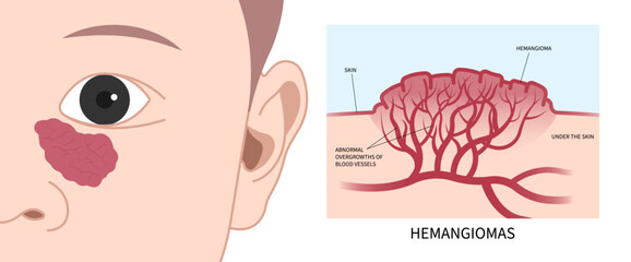 Transtorno tumoral infantil facial com hemangioma na doença