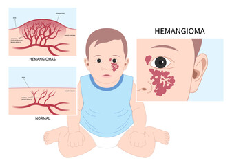 Pigmented birthmarks and Hemangioma on Facial child tumor disorder disease