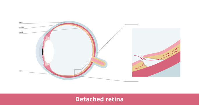 Detached retina (retinal detachment). The thin layer at the back of the eye (retina) becomes loose.  Retina lifts away from the back of the eye and does not work, making vision blurry.