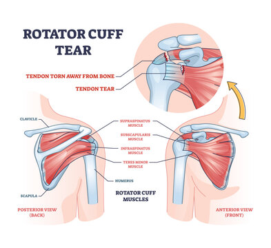 Rotator cuff tear as shoulder muscle trauma or arm injury outline diagram. Labeled educational upper body anatomy with medical tendon torn away from bone vector illustration. Painful joint condition.
