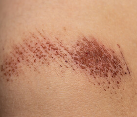Fototapeta premium scratches on the skin of the leg as a background