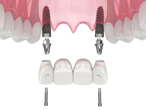 3d render of jaw with de3d render of jaw with dental incisors bridge supported by implantsntal incisor cantilever bridge