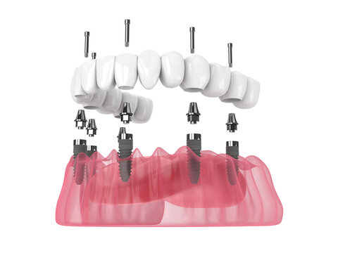 3d render of mandibular prosthesis all-on-6 system supported by implants
