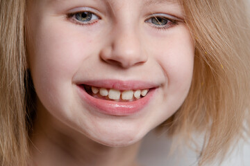 Girl shows teeth with a gap, malocclusion