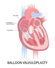 mitral valve disease the cardiac heart murmur of Cath lab for TAVI or TAVR stroke aortic repair right left atrial fever atresia floppy with Barlow birth syndrome rhythm atrium balloon surgery - obrazy, fototapety, plakaty