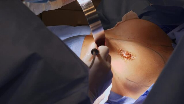 Surgery to change the shape of the breast in a woman.
