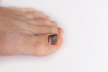 Subungual hematoma present under the toenail of the hallux, more commonly known as the big toe. broken toenail is when blood forms under a fingernail or toenail. Blue black toenail.