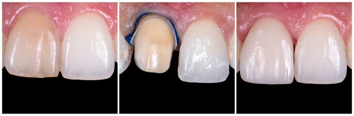 dental photography of dental work ceramic crowns and veneers
