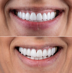 dental photography of dental work ceramic crowns and veneers