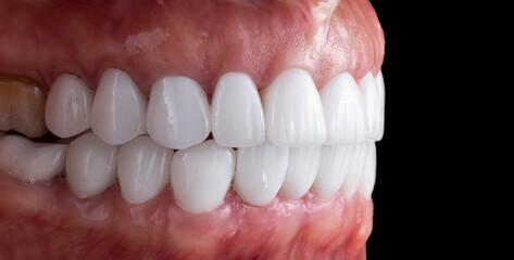 dental photography of dental work ceramic crowns and veneers