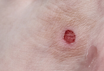Not a big bloody wound on the skin of the leg.Damaged skin.Capillary layer.