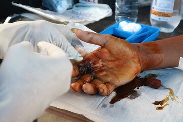 hand surgery performed quickly and precisely