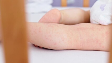 atopic eczema dermatitis sleeping baby legs, red irritation allergic disease. child kid lying on white bed showing red atopy skin rash on leg. dermatology allergy illness concept medicine and health