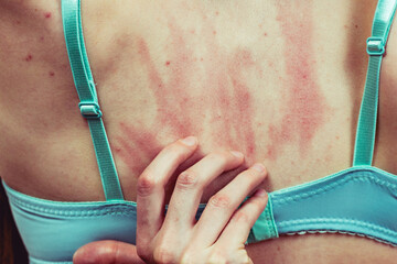 Woman scratching her itchy back with allergy rash