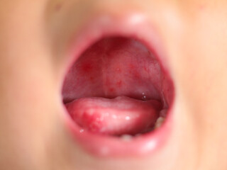 Hand foot mouth disease rash of skin hand medical child virus infection disease. - obrazy, fototapety, plakaty