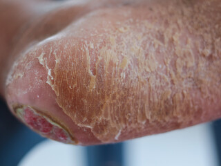 wound infaction to skin  diabetes melitus.