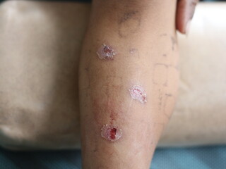Gout symtom arthriti inflammation to toe and foot skin.
