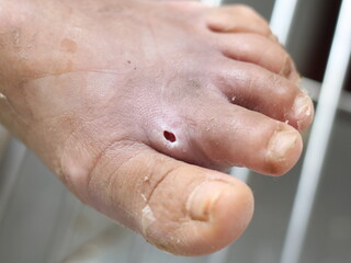wound infaction to skin  diabetes melitus.