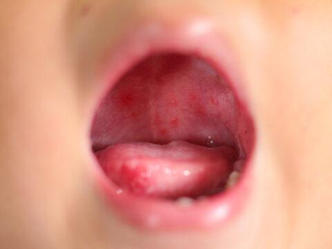 Hand foot mouth disease rash of skin hand medical child virus infection disease.